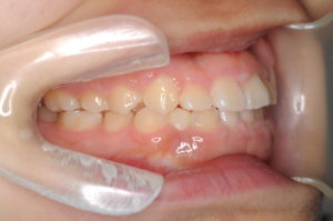 つくば・土浦の矯正歯科　つるみ矯正歯科　歯並び矯正症例A　叢生（乱杭歯）2b